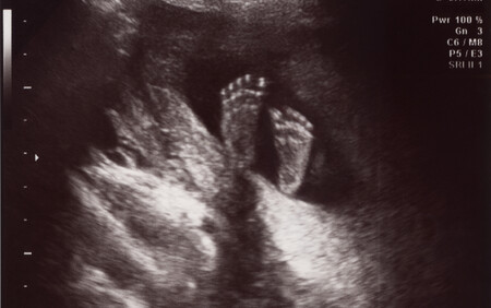 baby scan